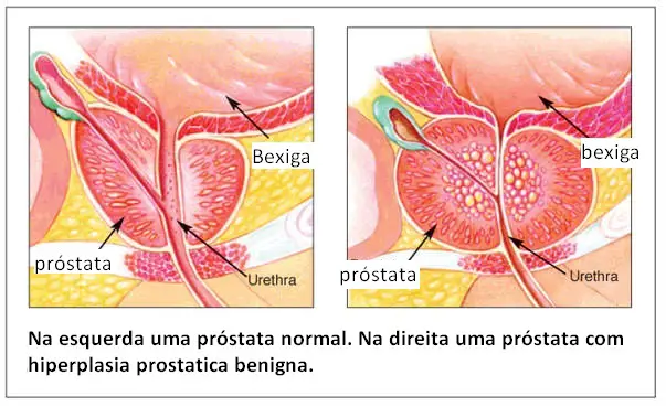 hiperplasia prostata