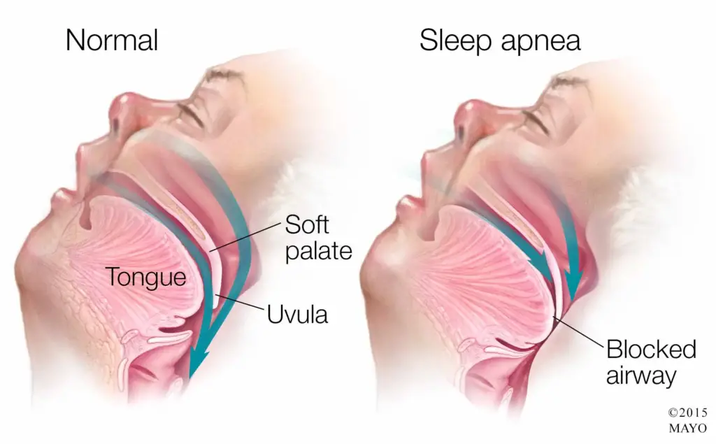 apneia do sono